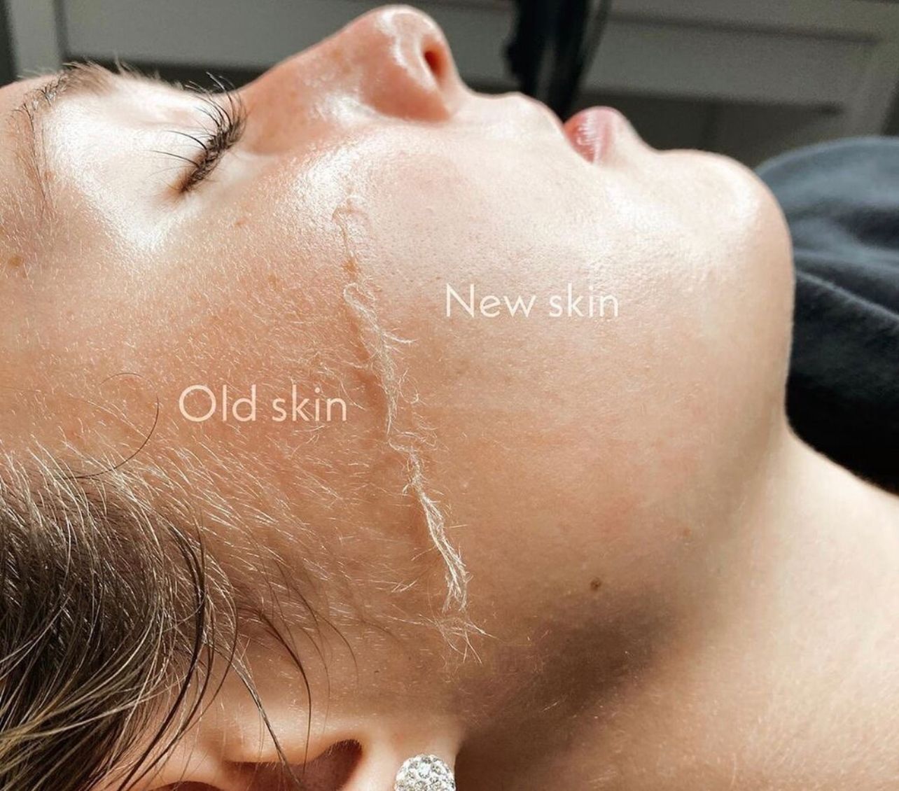 Derma-plane Facial - Course