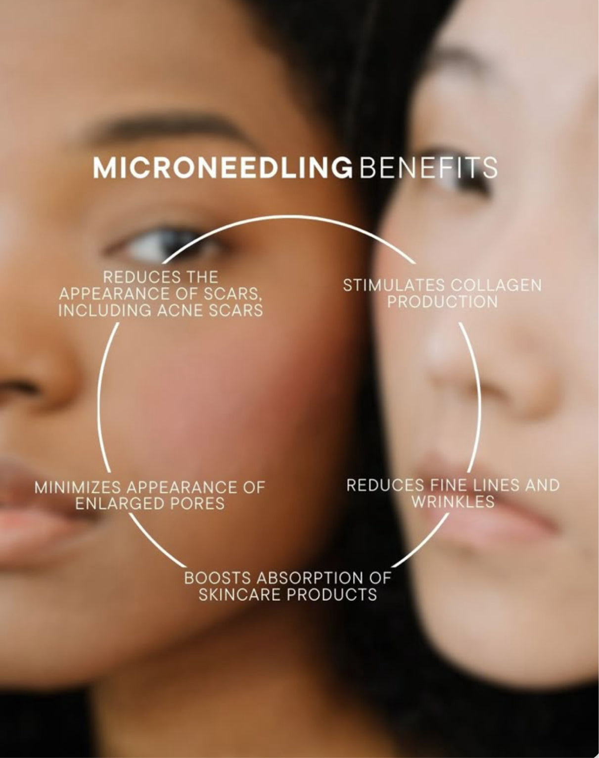 Microneedling