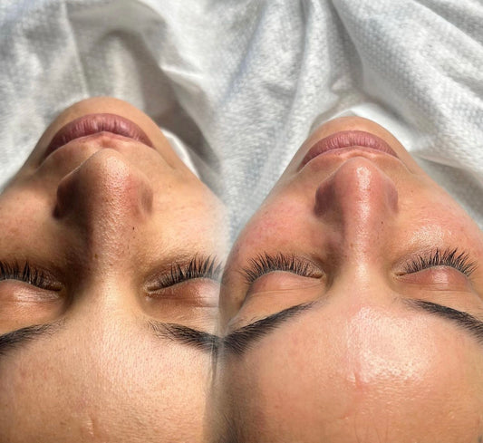 Luxury HydraFacial